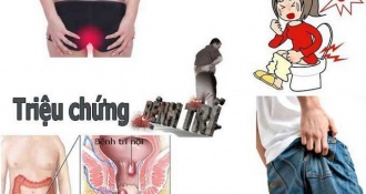 Nguyên nhân gây trĩ hỗn hợp là gì? Cách chăm sóc và điều trị bệnh